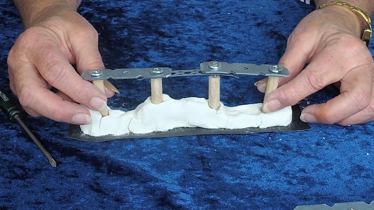 4 0n 1 Implants Construction principles & potential Tension   Issues