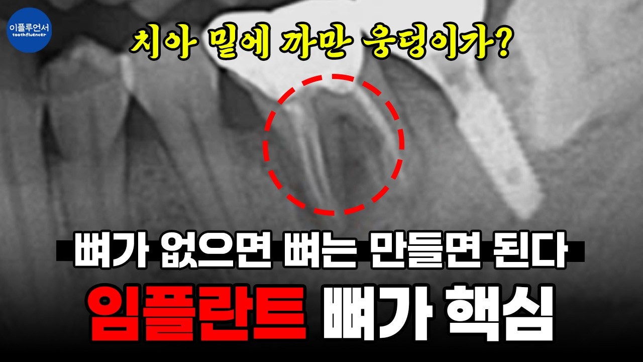 이가 없으면 잇몸으로 NO! 뼈가 없으면 만들어요