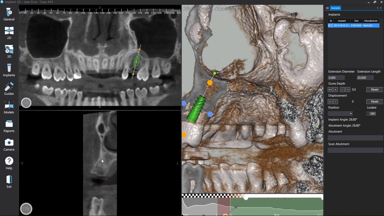 Implant 3D Tutorial - Implant Planning
