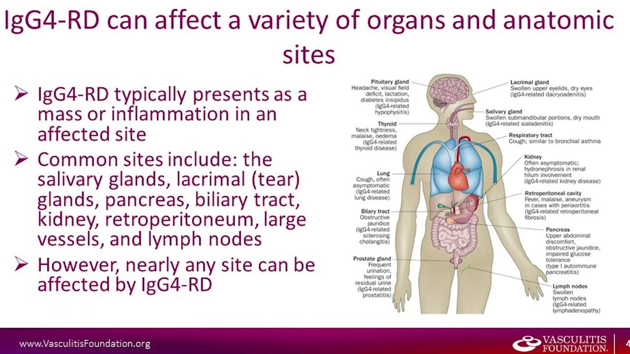 IgG4 Related Disease