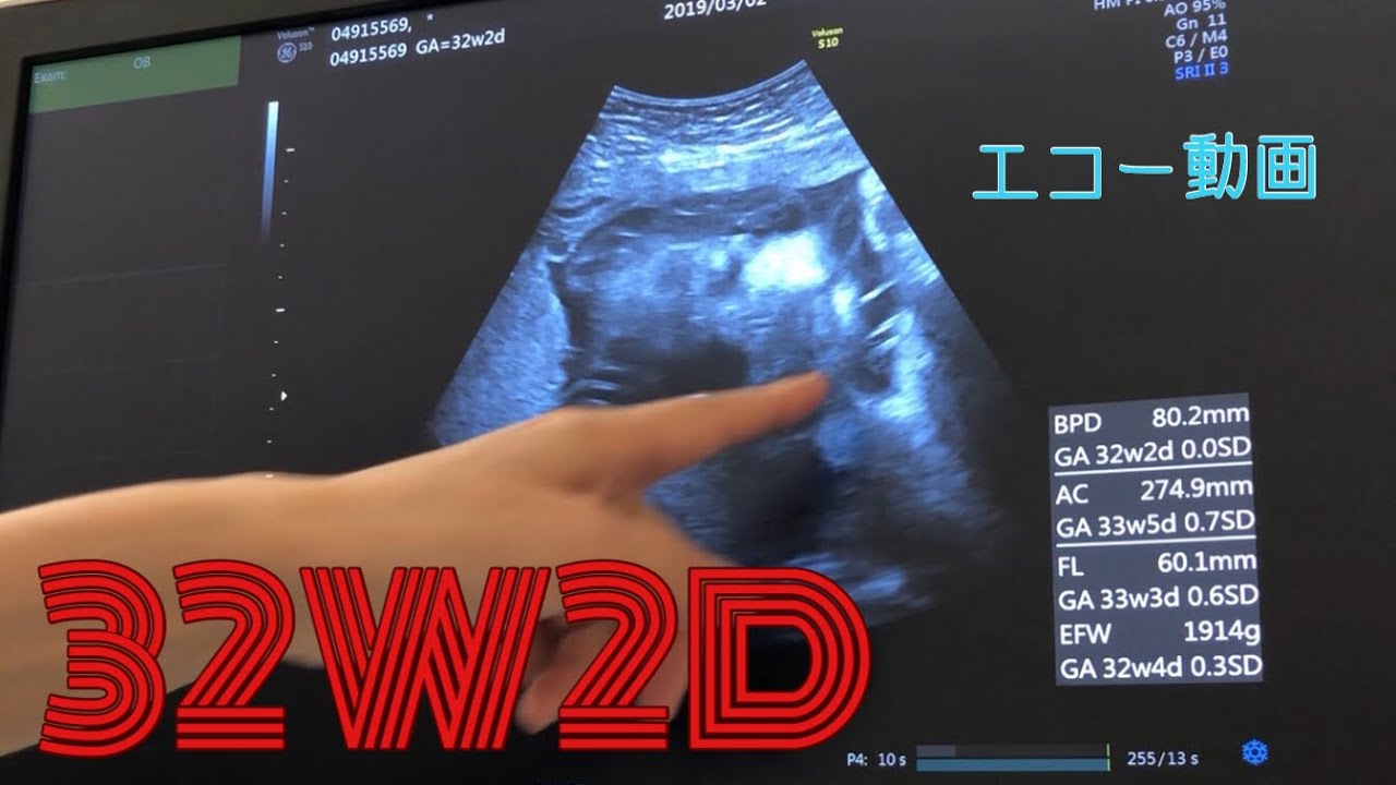 32週2日(32W2D) 妊娠9ヶ月 逆子の赤ちゃん 超音波エコー動画