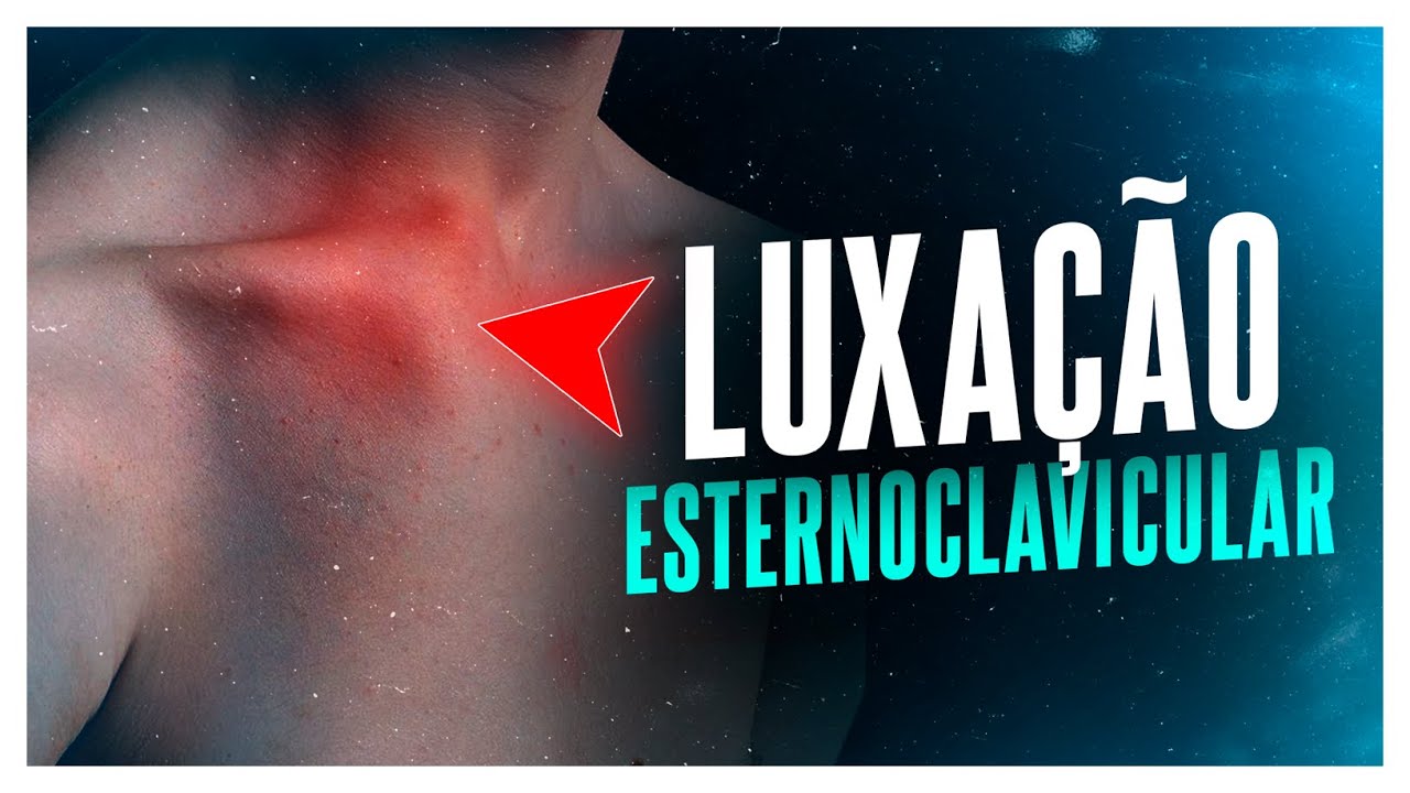 LUXAÇÃO ESTERNOCLAVICULAR