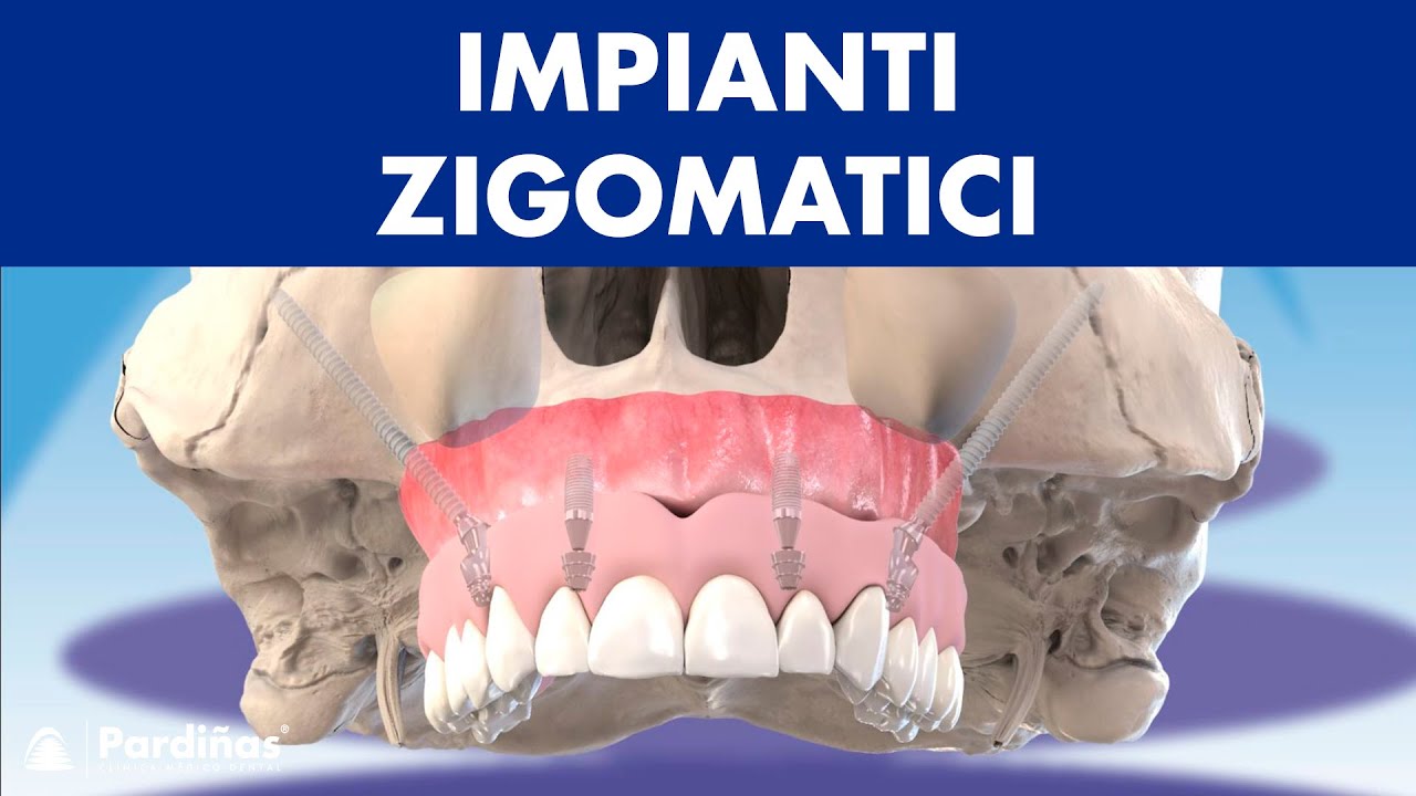 Impianti ZIGOMATICI - Come posizionare gli impianti in pazienti con POCO OSSO ©