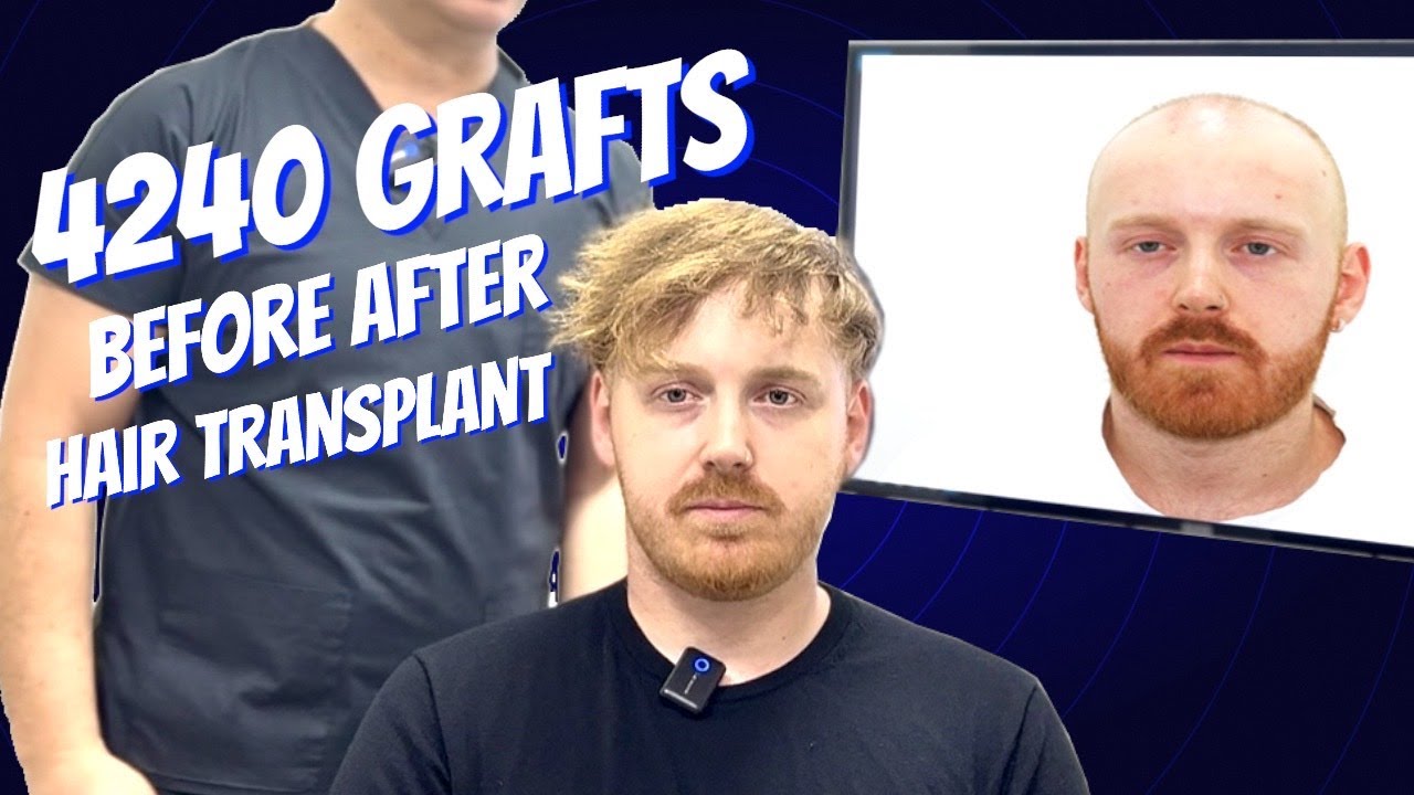 2 Sessions Hair Transplant for Norwood 7 : 1,5 Years Result of the First Session