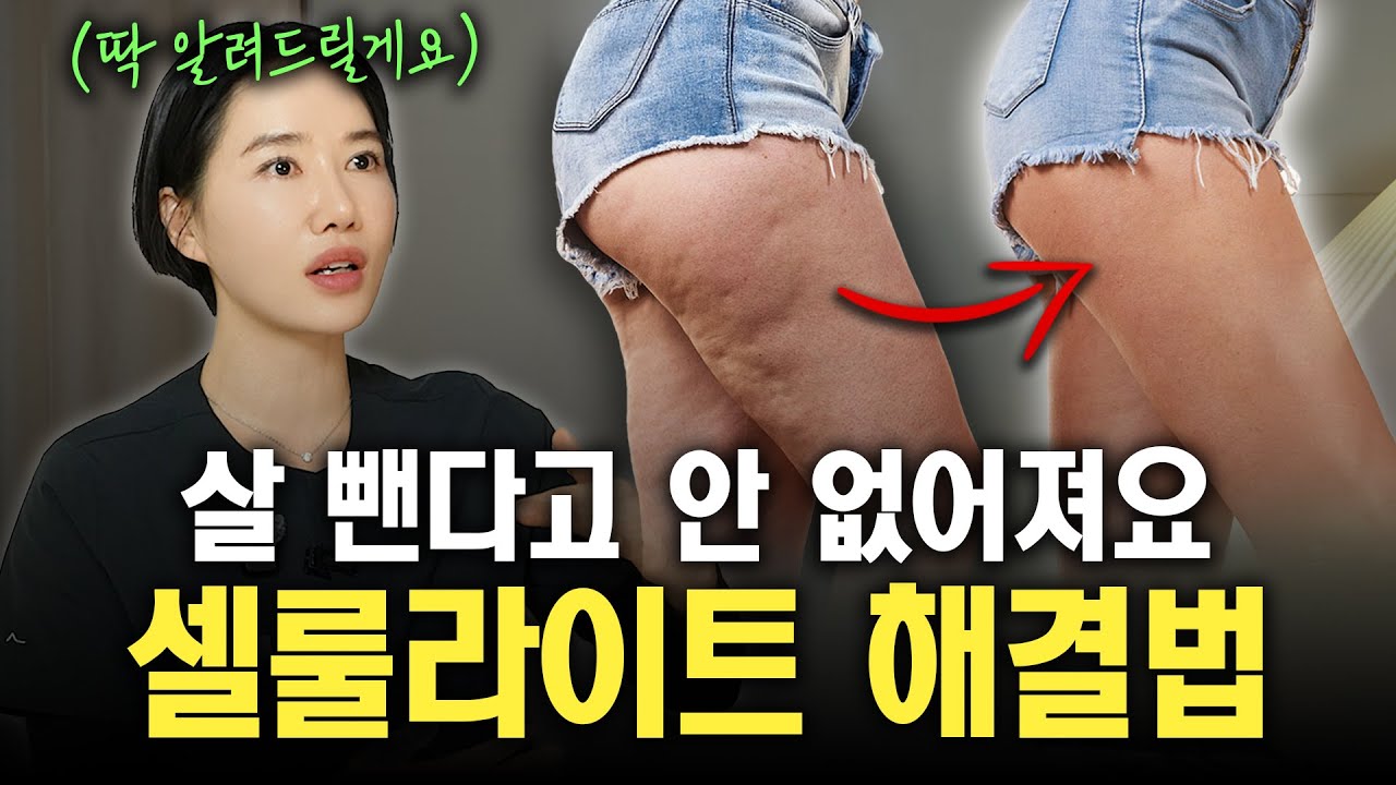 셀룰라이트의 실체, 알고 계시나요? 살 뺀다고 다 없어지지 않습니다!