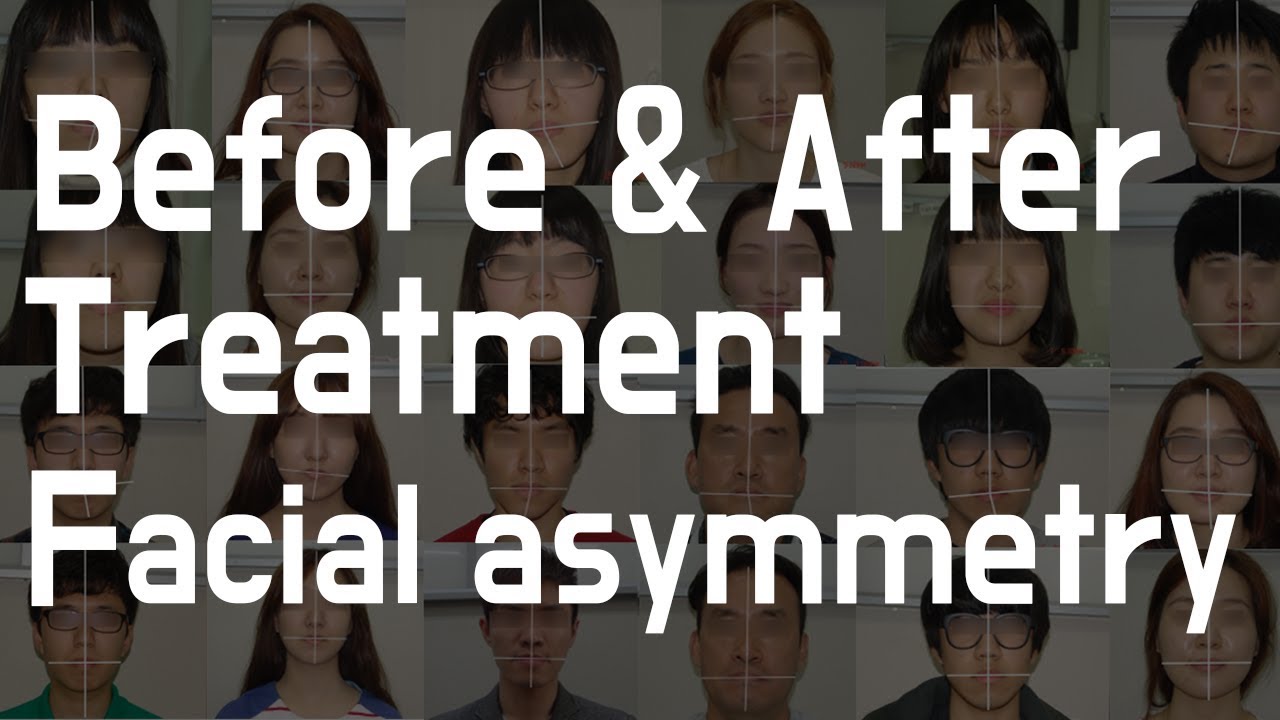 Before and After treatment for facial asymmetry 2
