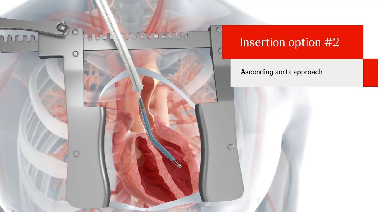 Impella 5.5 with SmartAssist (Gen 2) Product Animation