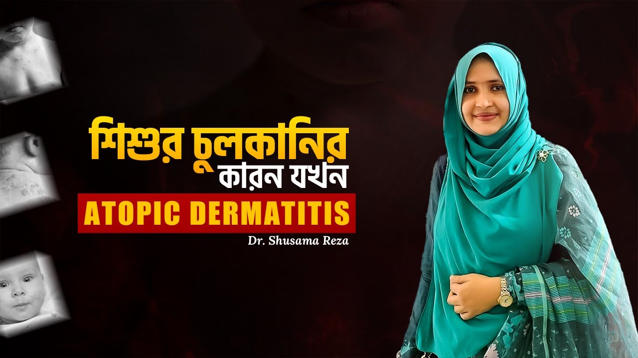 শিশুর চুলকানির কারন যখন Atopic Dermatitis ? | Dr. Shusama Reza