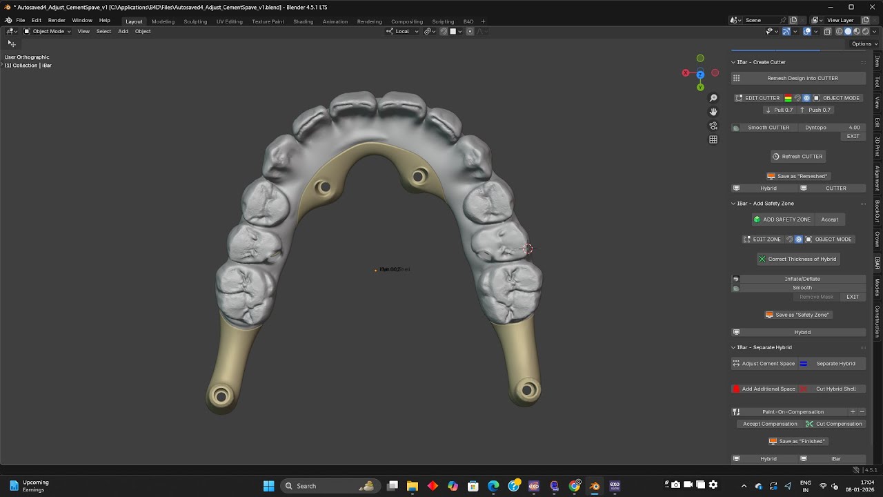 Ibar designing for upper & lower arch all on x implants 3b tb protocol- best laser  -chennal