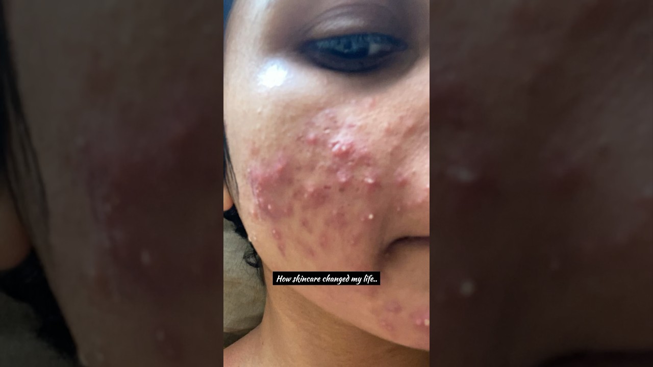How skincare changed my life 🌸