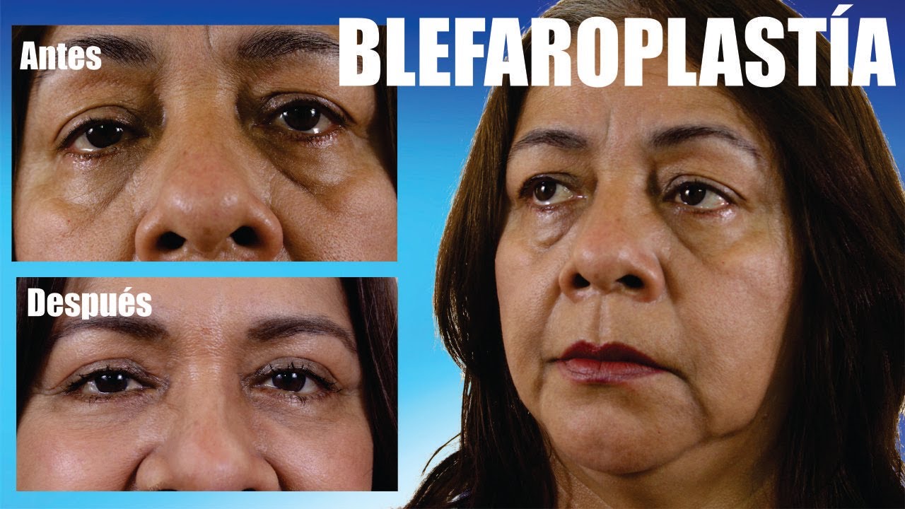 BLEFAROPLASTÍA Superior e Inferior 👀 LIPOINJERTO Cirugía párpados❤️ Dr PERCY NEVADO Cirugía Plástica