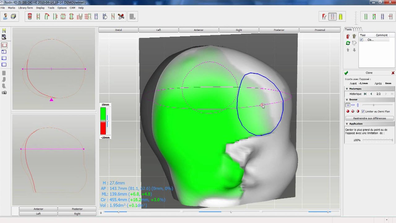 Rodin4D CAD/CAM system for prosthetics and orthotics