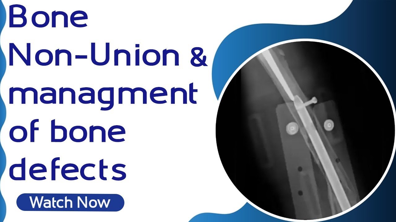 Bone Non-Union & management of bone defects | Orthopaedic Academy