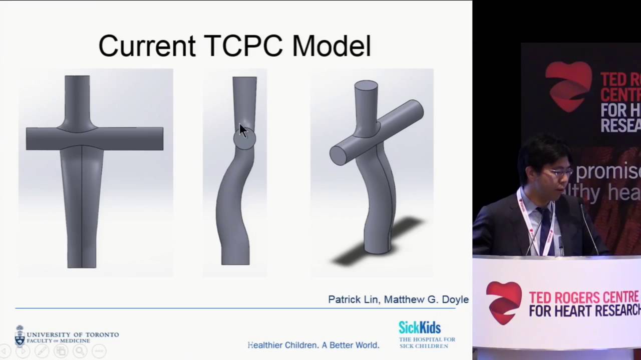 Development of a novel device for treatment of failing Fontan circulation