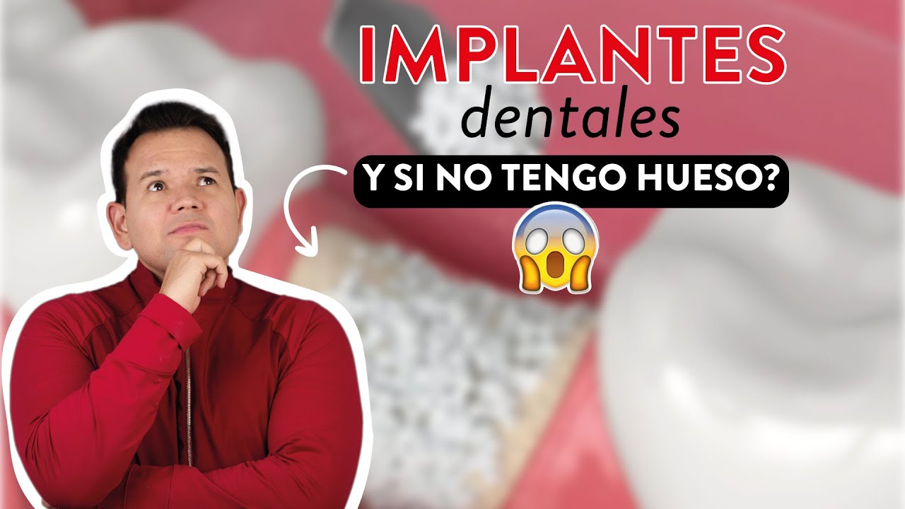 Opciones de implantes dentales cuando no hay hueso! SI HAY SOLUCI&Oacute;N 🙌