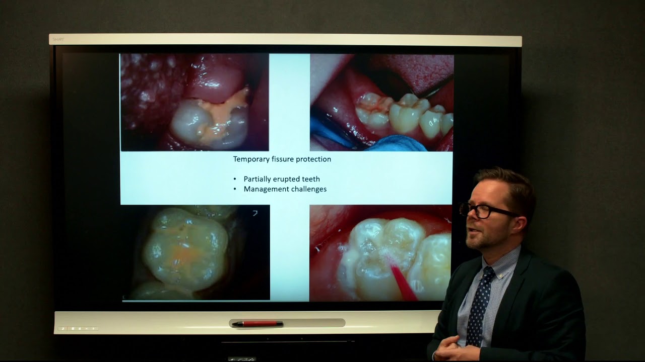 glass ionomer sealants