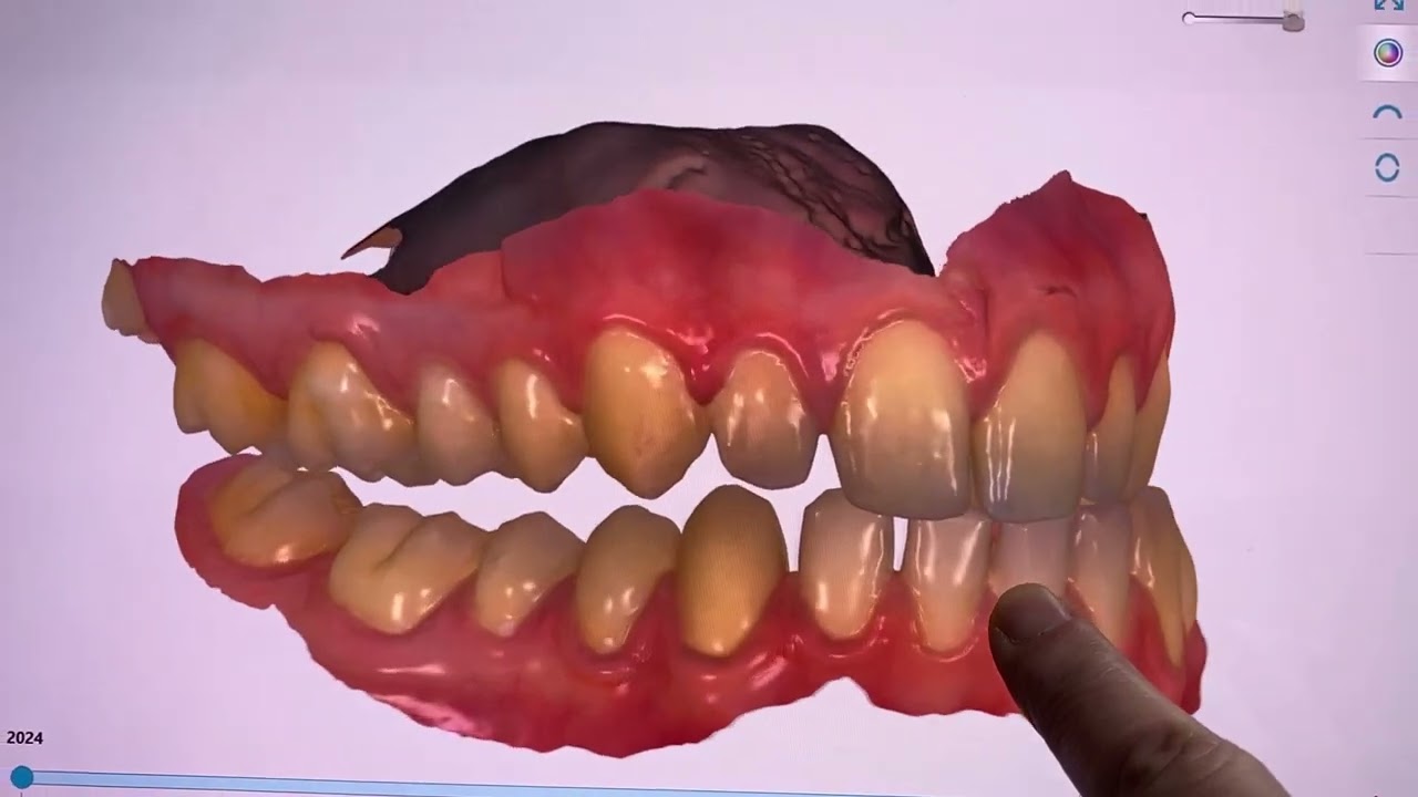 Deviazione Mandibolare, dall'occlusione abituale all'occlusione fisiologica - Caso clinico