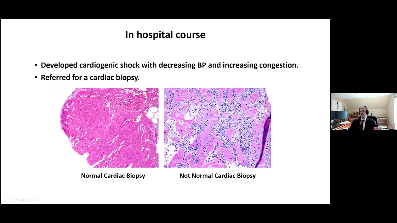 Advanced Cardiac Imaging Among Patients with Cardiovascular Complications From Cancer Immunotherapy