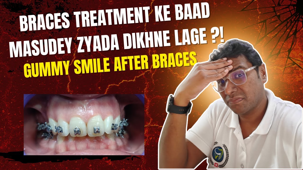 Braces सही लगे थे… फिर भी Gummy Smile कैसे आ गई? डॉक्टर का खुलासा GUMMY SMILE AFTER BRACES| Dr Rudra