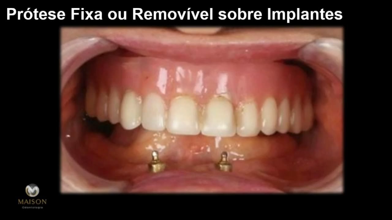 Implante Dentário - Prótese Fixa ou Removível ?
