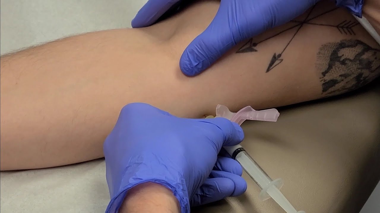 Golfer's elbow (medial epicondylitis) trigger point injection plus update