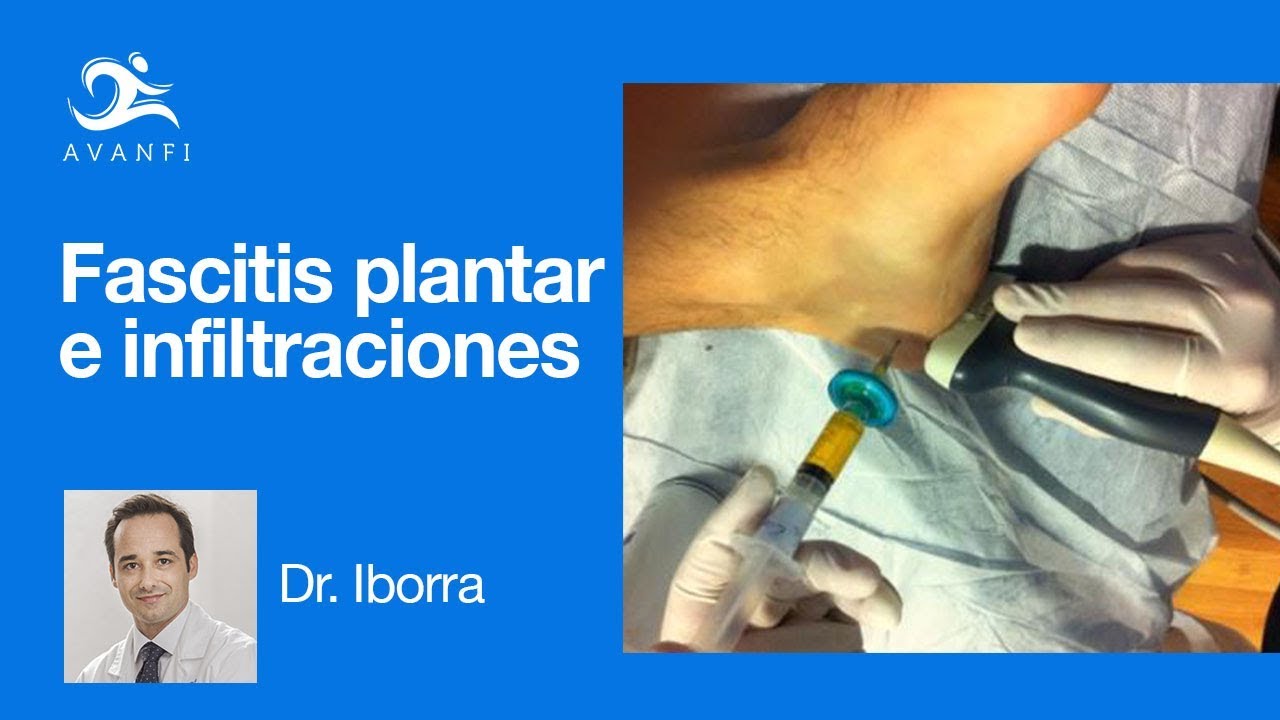 Infiltraciones para la fascitis plantar: causas reales y tratamiento regenerador