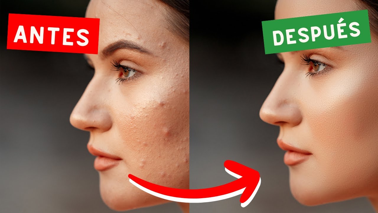 C&oacute;mo quitar espinillas sin dejar marcas | Health Tips