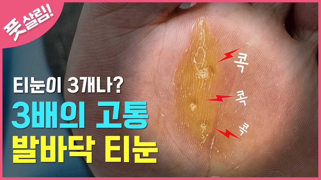 발바닥 굳은살에 티눈이 3개나? 이제는 참을 수 없어 찾아왔어요. [풋스올서초이수점]