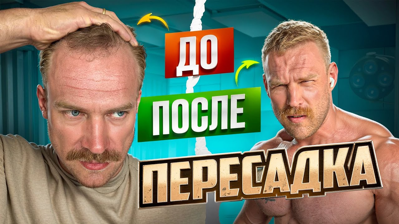 СДЕЛАЛ ПЕРЕСАДКУ ВОЛОС В ТУРЦИИ И ПОЖАЛЕЛ?