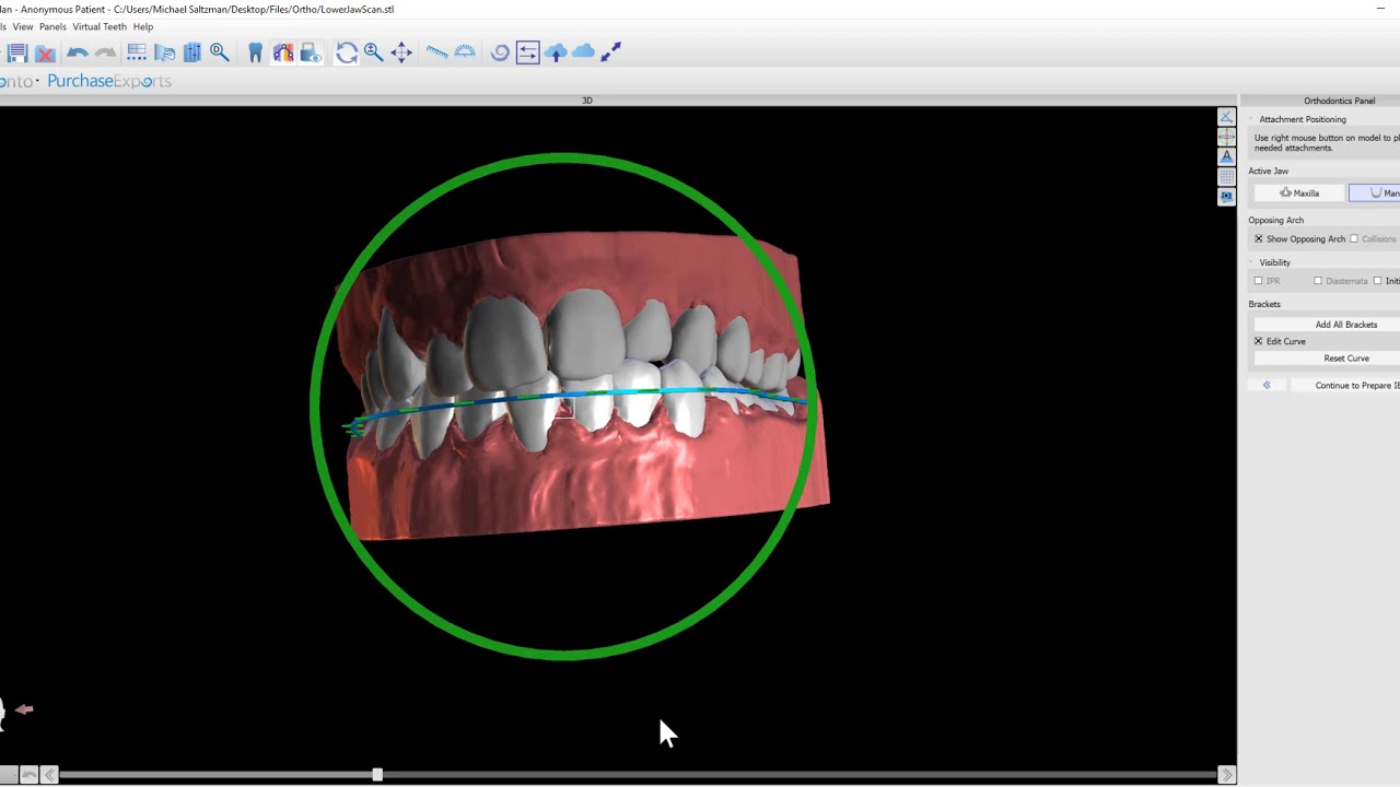 BSP 4.7 Ortho - Adding Brackets to Virtual Tooth Setup
