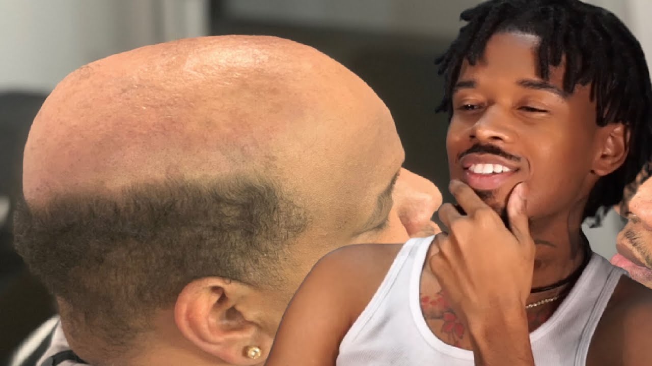 He LIED About His Hairline..