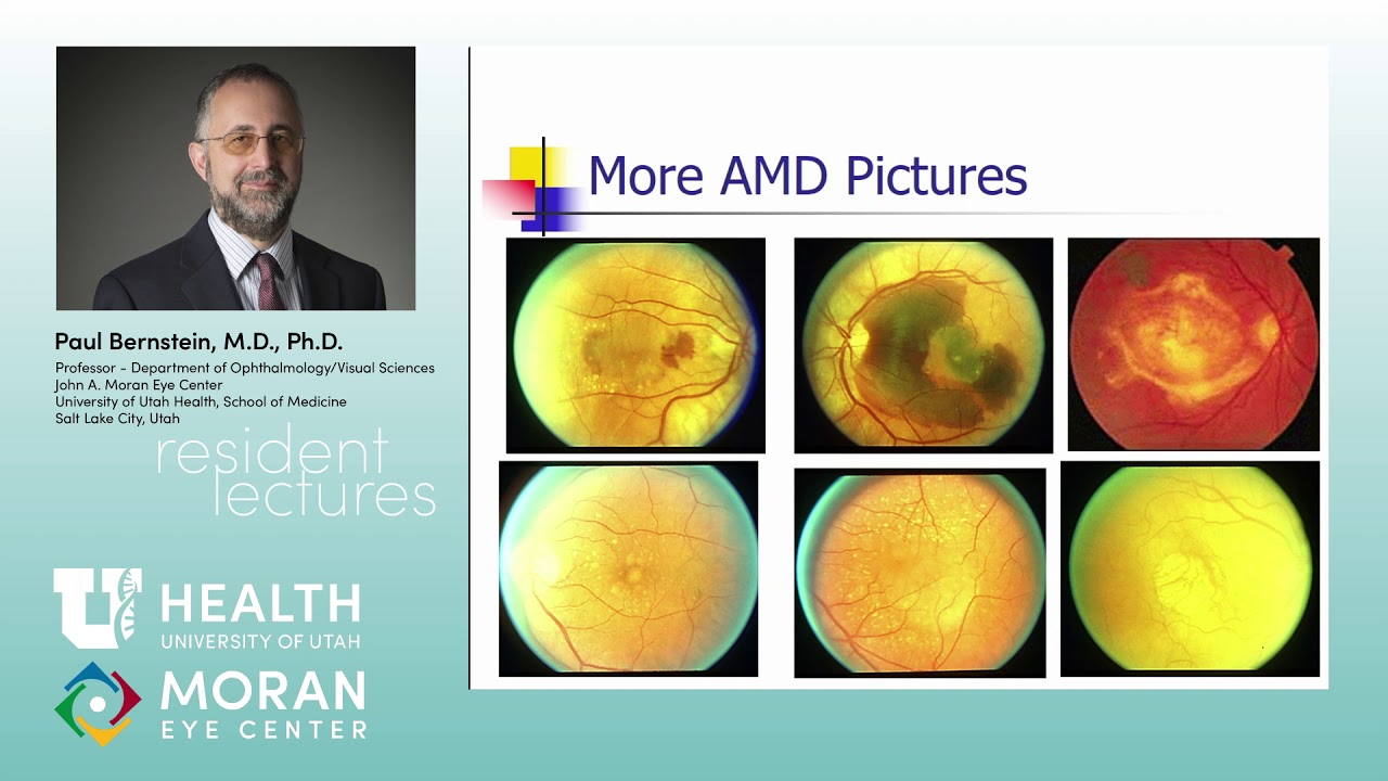 Age-Related Macular Degeneration