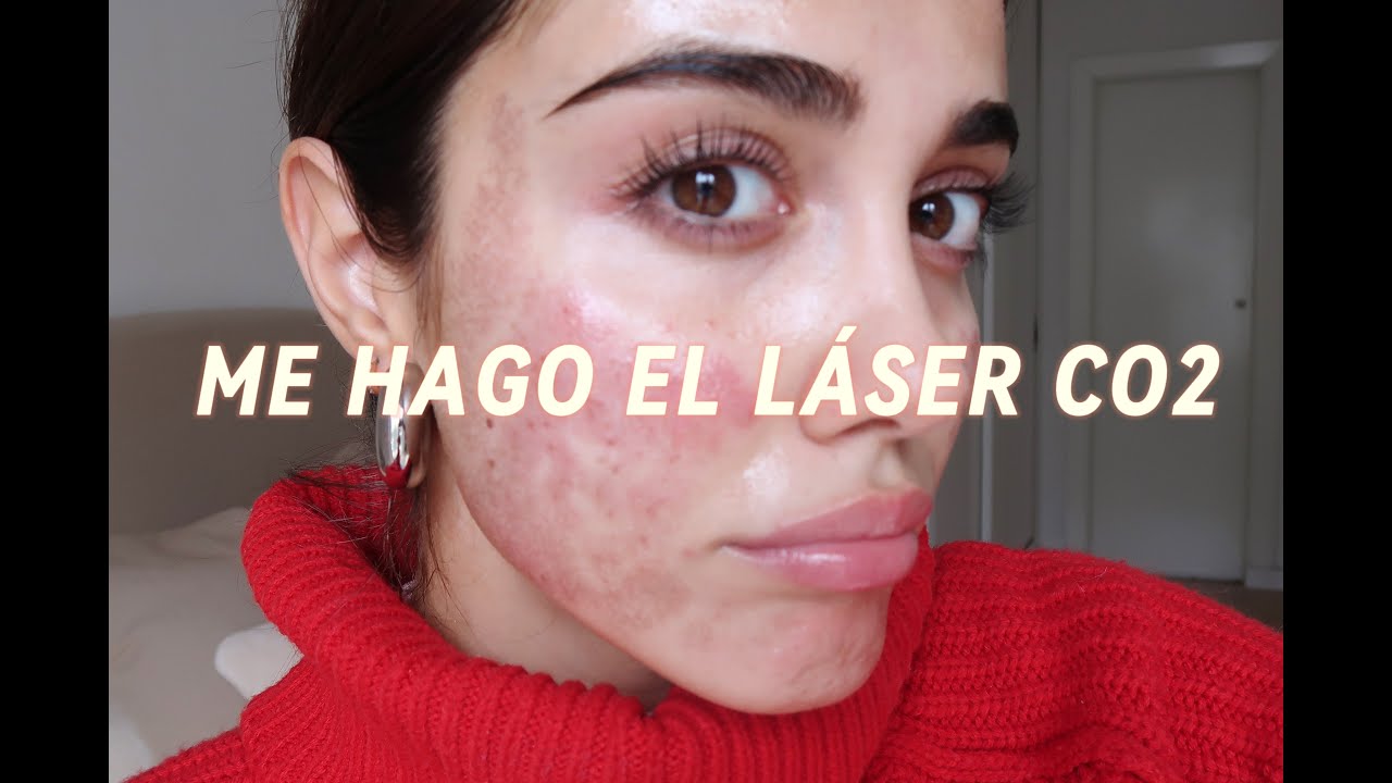 me hago el LÁSER CO2