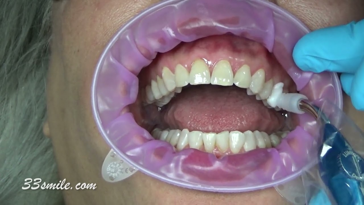 Cosmetic Dentistry Prepless Veneers Before and After