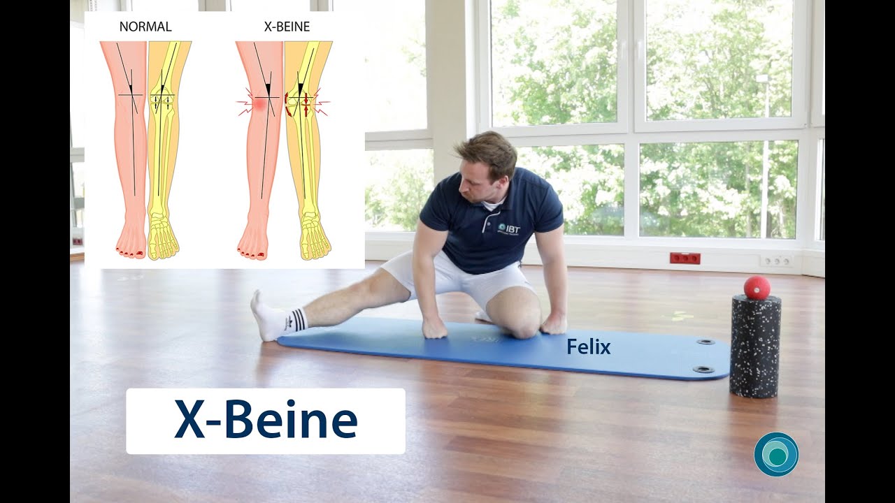 Übungen zum Beschwerdebild: X-Beine ( Genu Valgum ) | mit Felix
