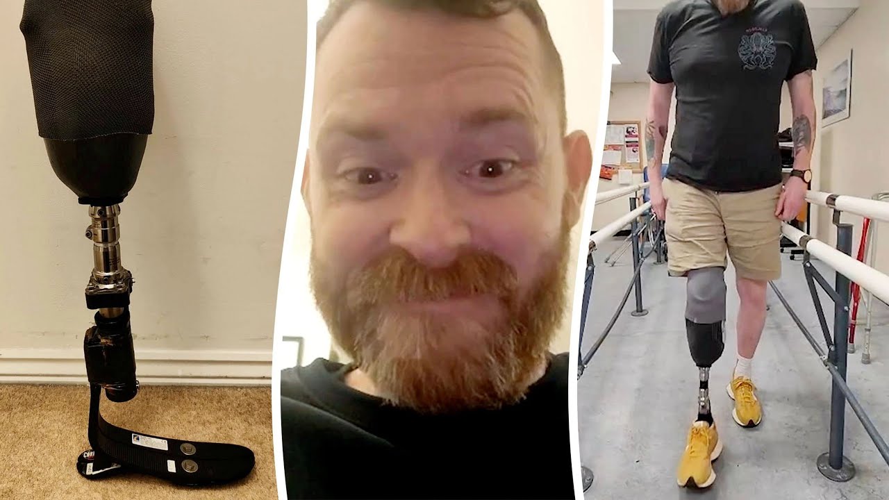 Man facing £35k bill for prosthetic leg builds one from Amazon for £100 | SWNS