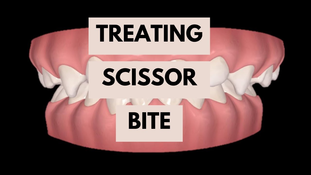 Management of Scissor Bite - Orthodontics