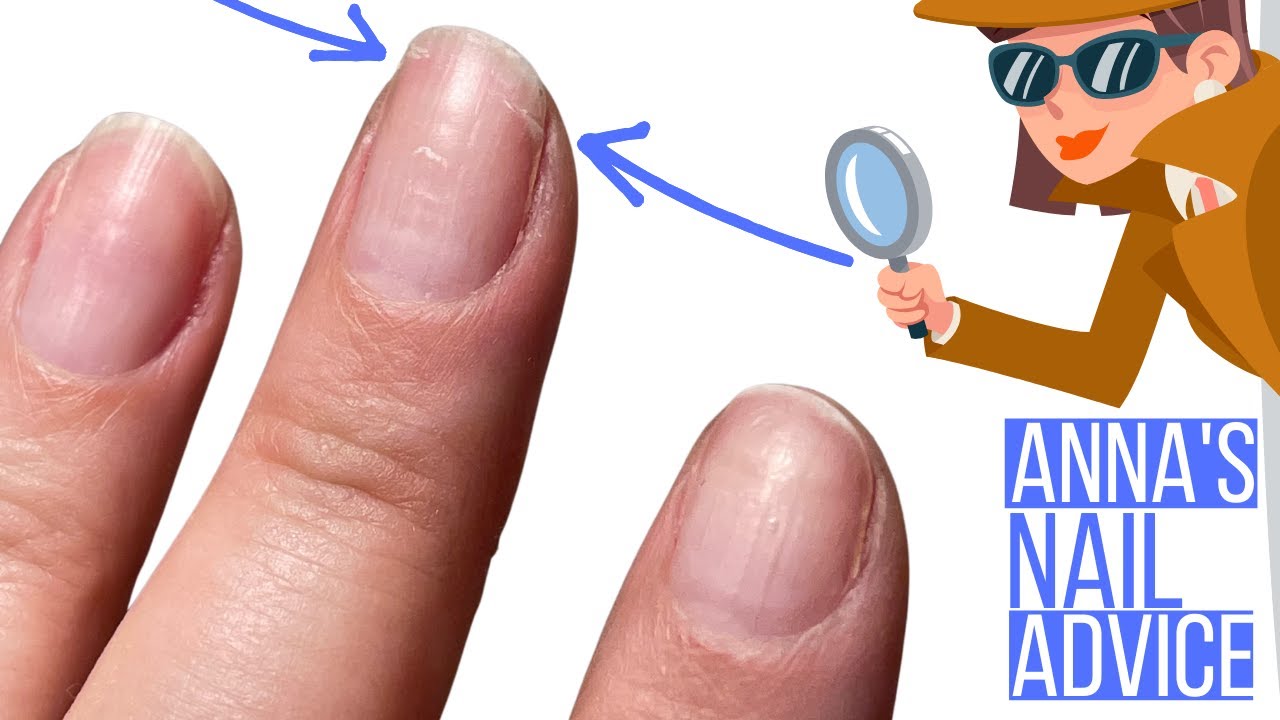 Torn Nails Problem [Anna's Nail Advice]