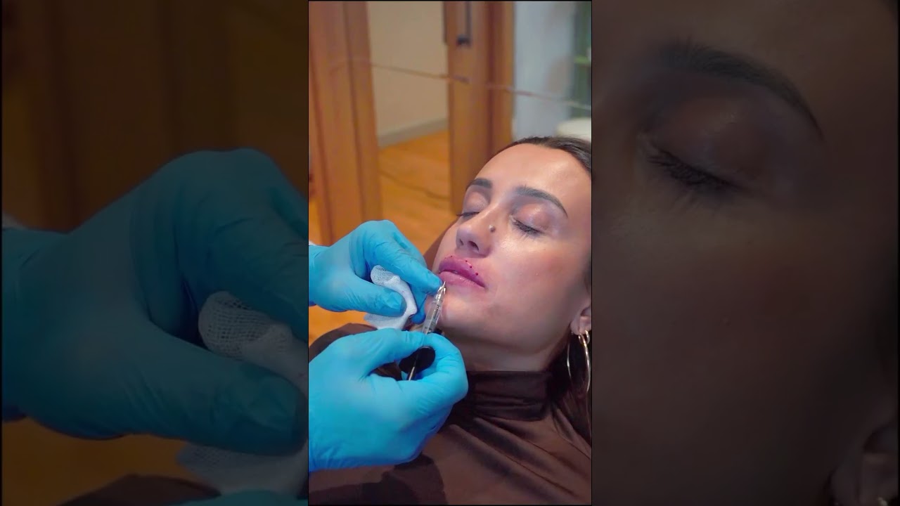 Doğal ve &Ccedil;ekici Dudaklara İlk Adım - Dudak Dolgusu #lipfiller