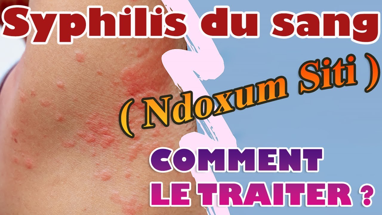 Syphilis du sang ou 