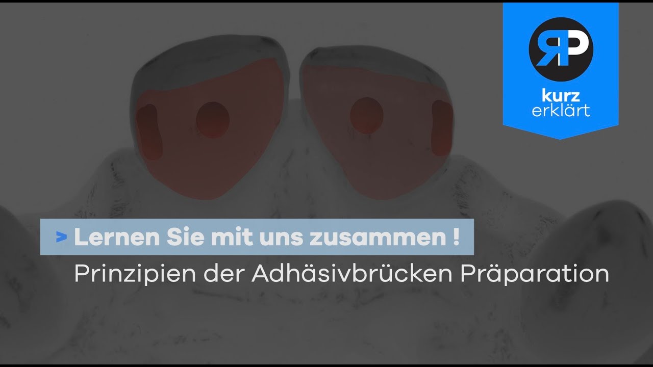 Präparation von Adhäsivbrücken // Kurz erklärt