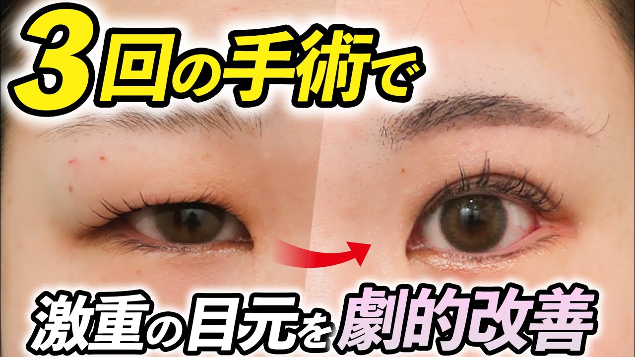 【人生を変えた目元フル整形】クリニックスタッフのリアルすぎるダウンタイムレポート【密着】