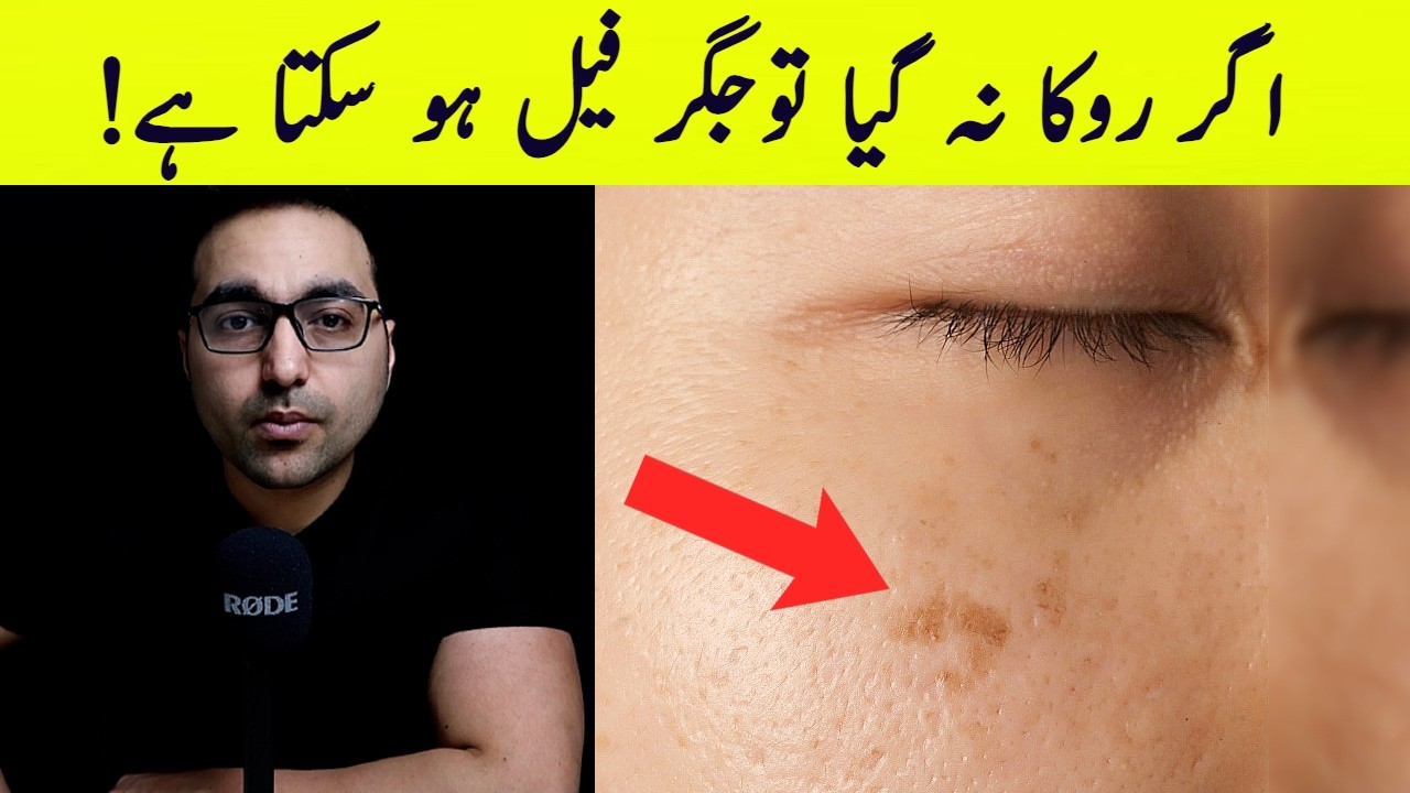 Jigar kharabi ki nishani! | Signs of Toxin Build-up in the Liver - Dr. Zee