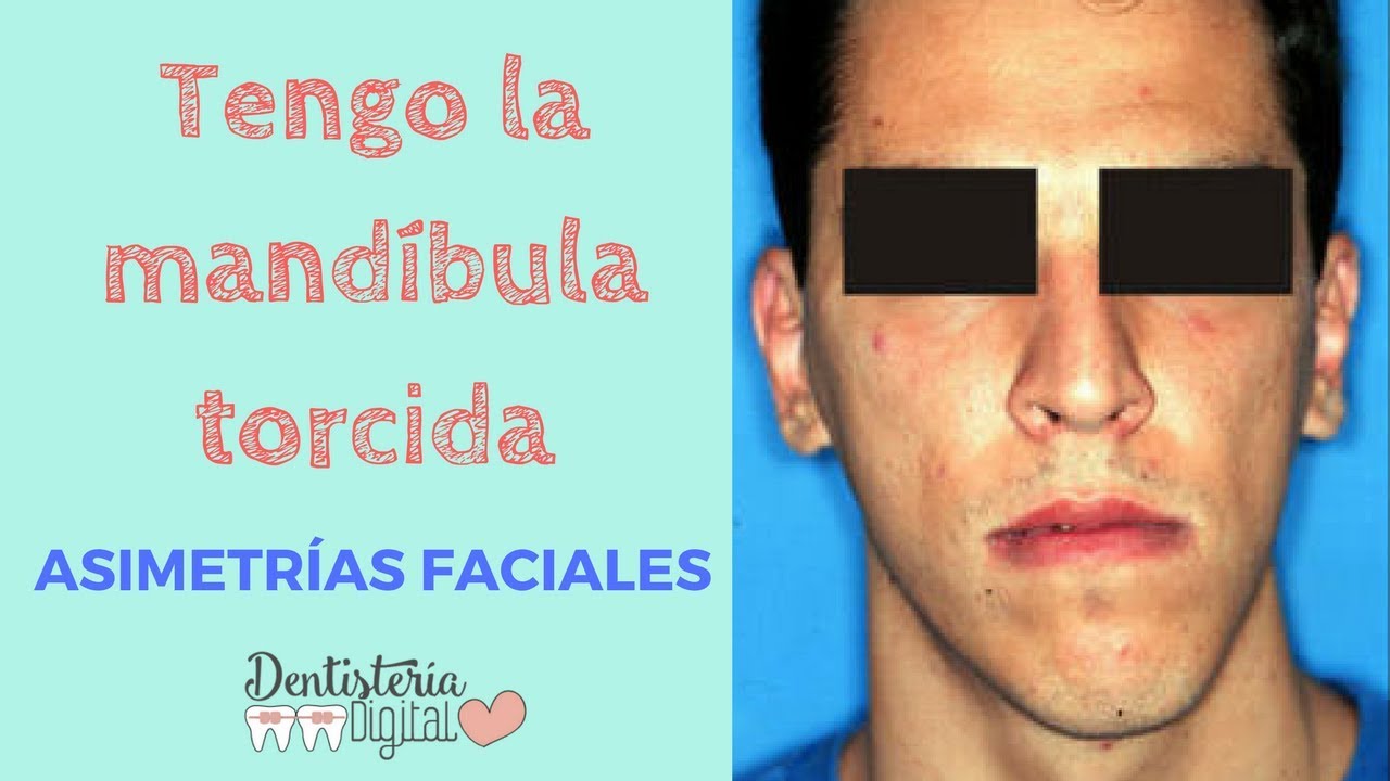 Tengo la mandibula torcida - ASIMETRÍAS FACIALES