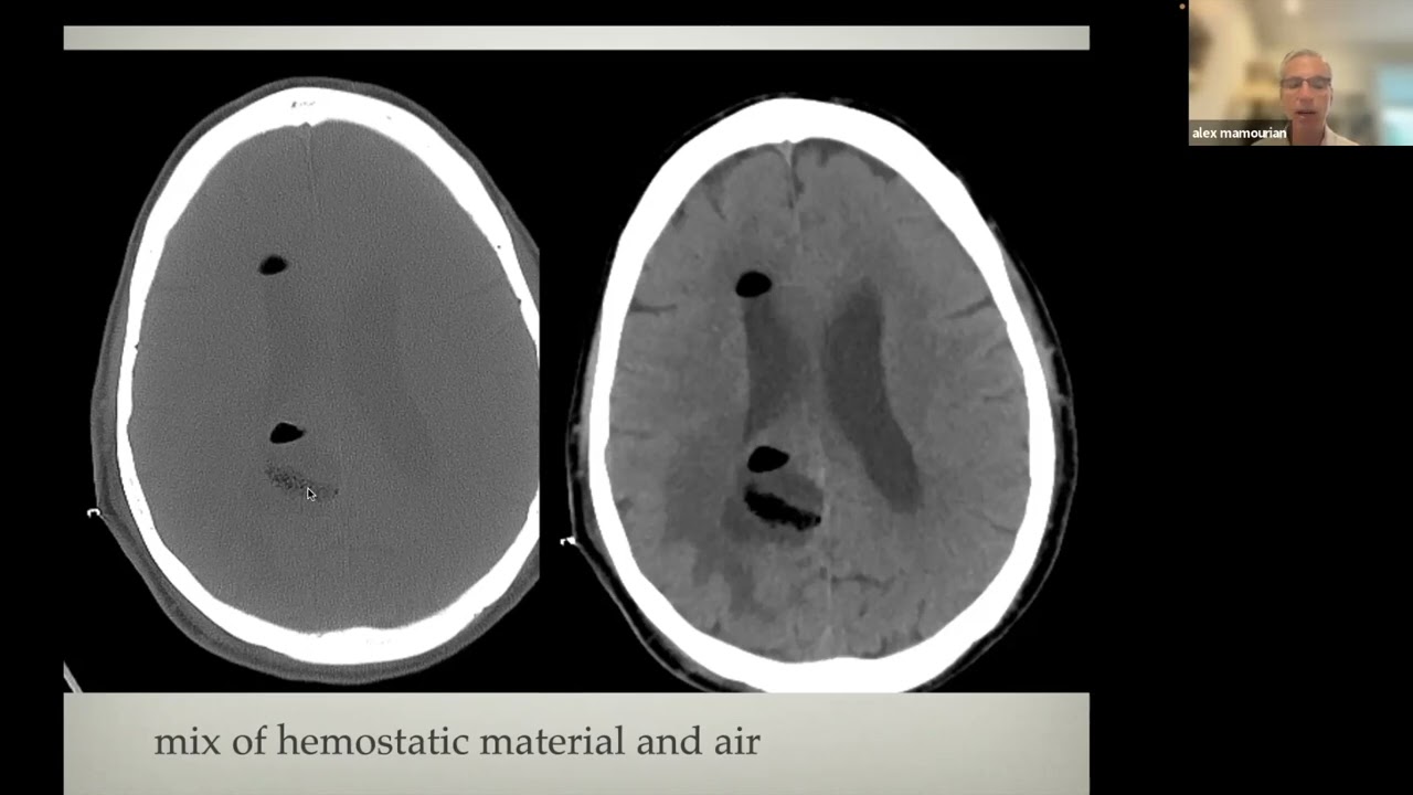 week 3- CT and MR imaging pitfalls when imaging the stroke patient   HD 1080p