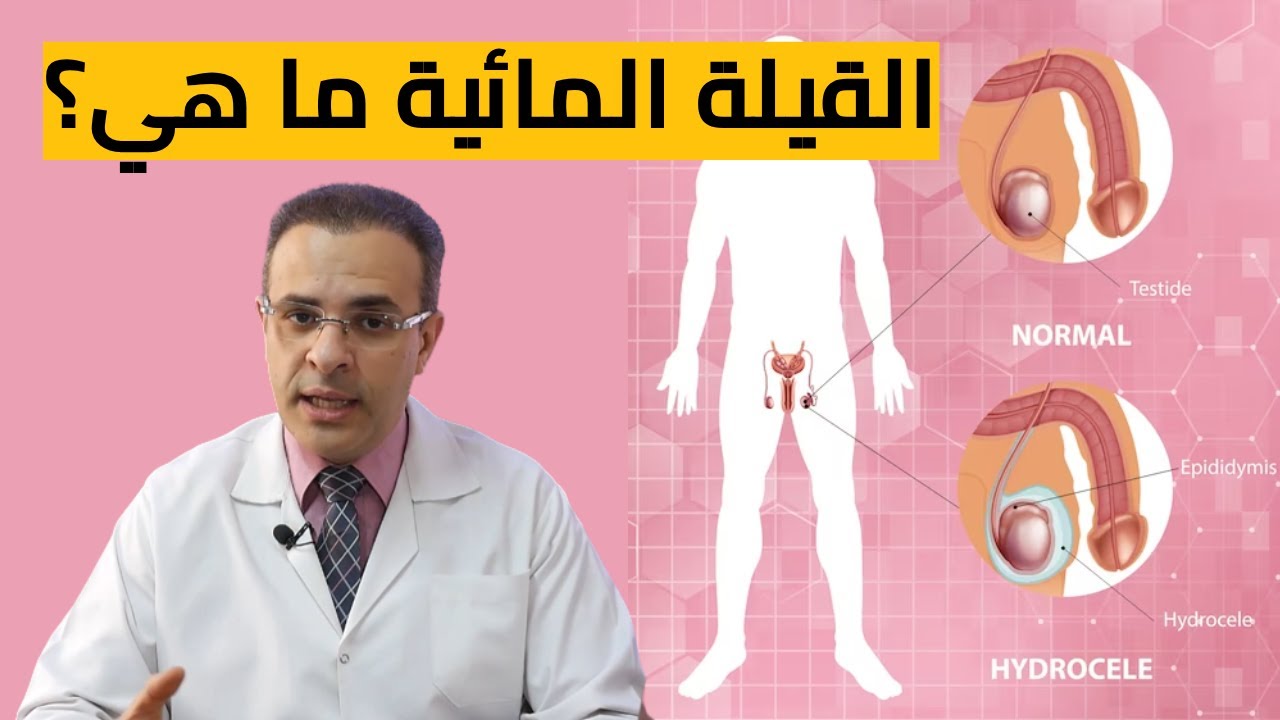القيلة المائية ما هي ؟