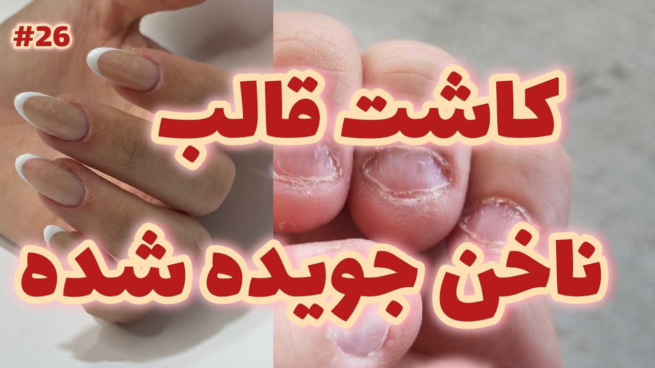 کاشت ناخن جویده شده🤩