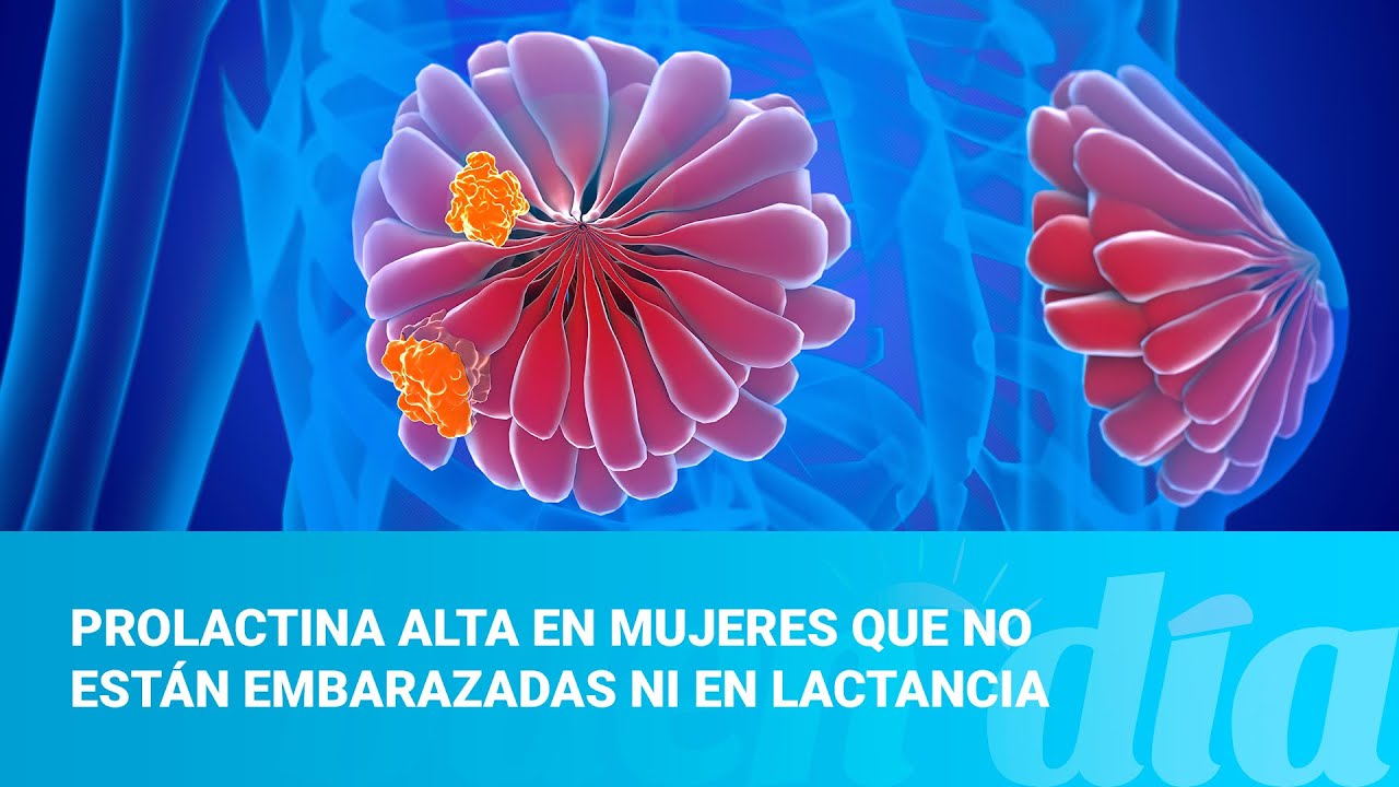 Prolactina alta en mujeres que no están embarazadas ni en lactancia