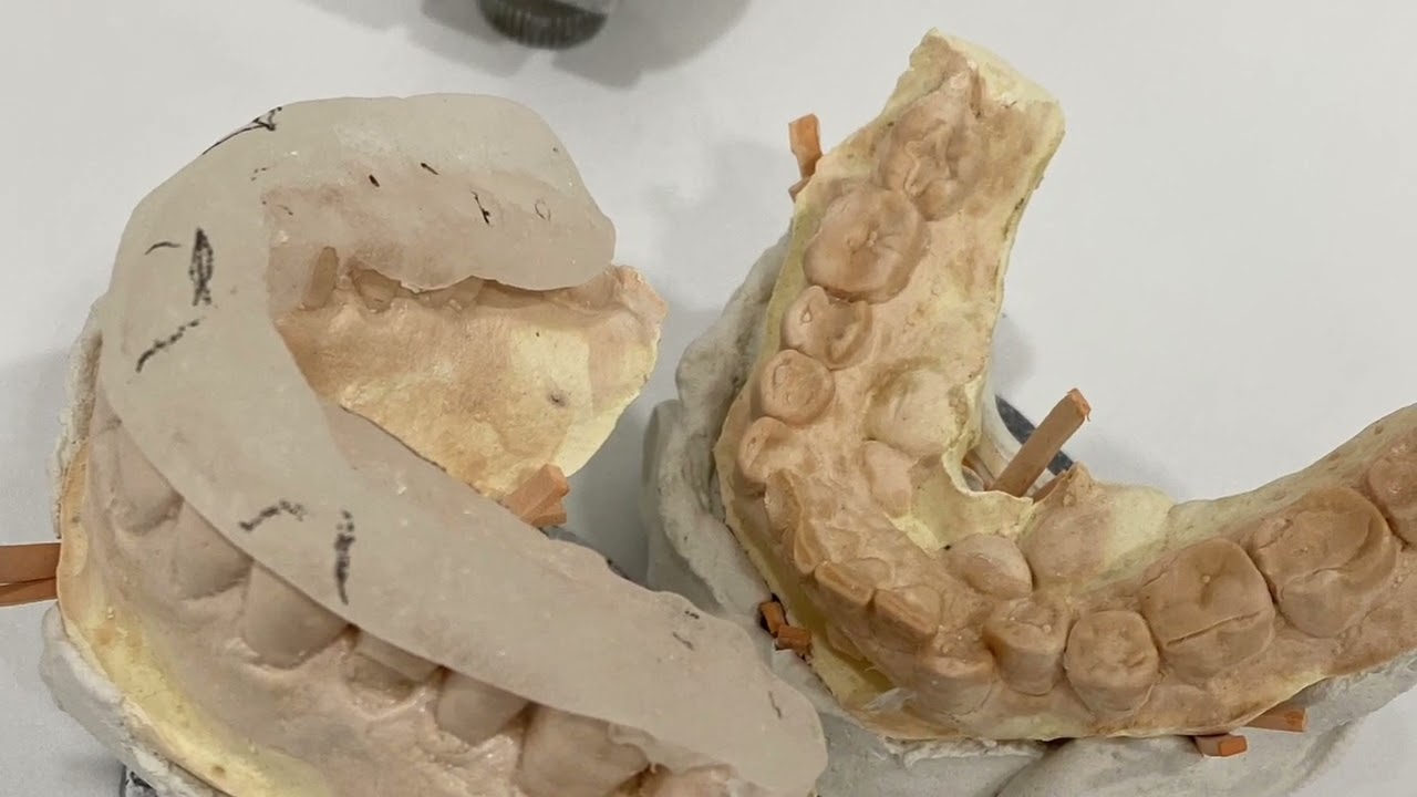 Confecção de placa oclusal estabilizadora