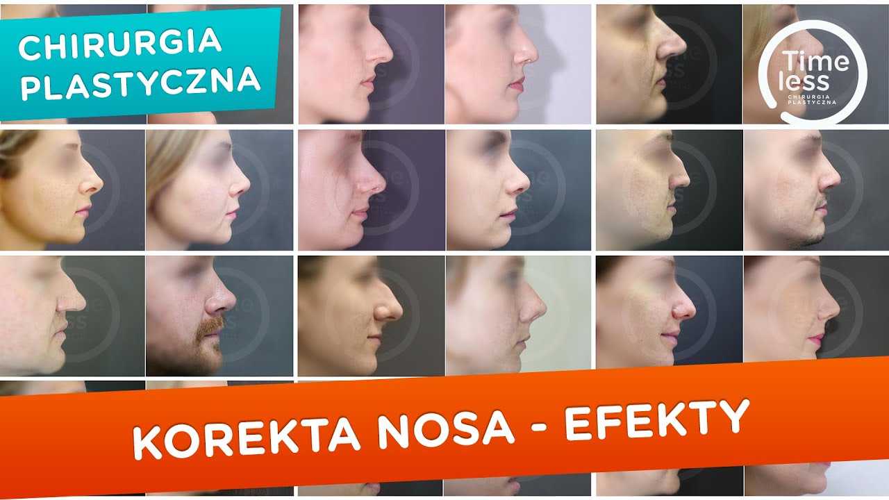 #Korekcjanosa, #rhinoplastyka - efekty po zabiegach korekty nosa